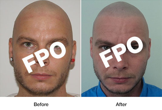 Sobe Scalp Micropigmentation - Before and After